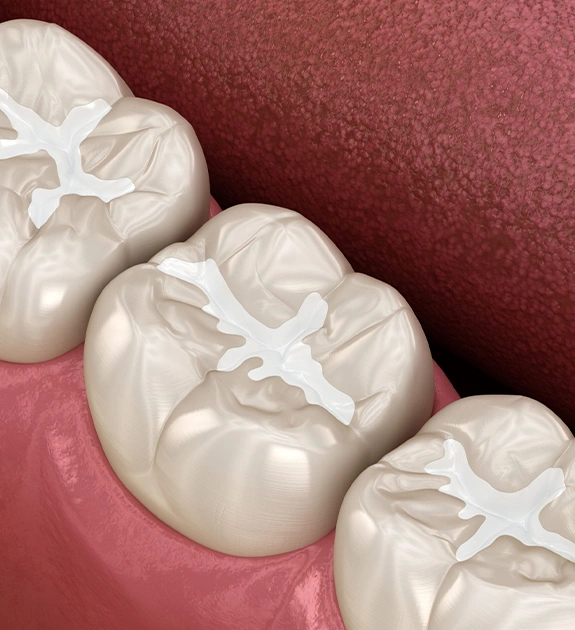 Dental Sealants St. Charles IL